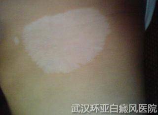 得了白癜风怎么预防 360截图20130523092557500.jpg