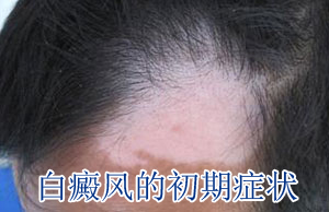 怎么有效避免白癜风的复发 怎么有效避免白癜风的复发