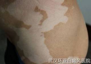 白癜风的预防需要做什么 27-111222150535391.jpg