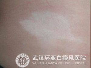 我们该如何预防白癜风的出现 1.jpg